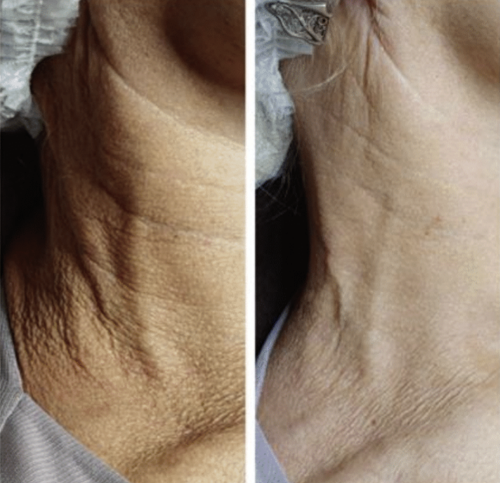 VITARAN HP CELL I, POLYNUCLEOTIDE SODIUM FROM SALMON PN - 20mg/mL 
SKIN - Innovatív biostimulátor lazac polinukleotidokkal, amely sejtszinten hat. 99,9% tisztasági tanúsítvány és igazolt minőség. KEVESEBB FÁJDALOM a szabadalmaztatott koreai technoló