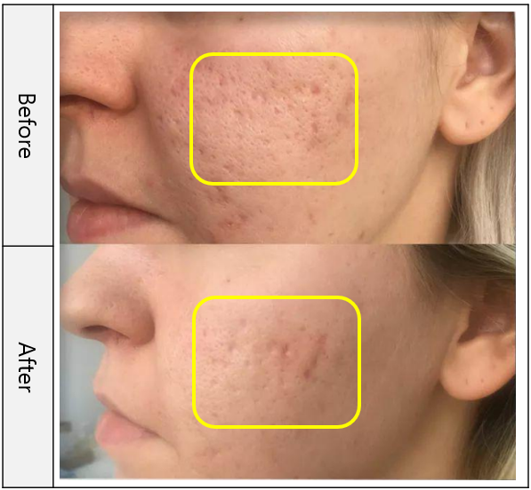 VITARAN HP CELL S, POLYNUCLEOTIDE SODIUM FROM SALMON PN - 20mg/mL 
SCAR & SKIN - Innovatív biostimulátor lazac polinukleotidokkal, amely sejtszinten fejt ki hatást. Tisztasági tanúsítvány és igazolt minőség. KEVESEBB FÁJDALOM a szabadalmaztatott kor