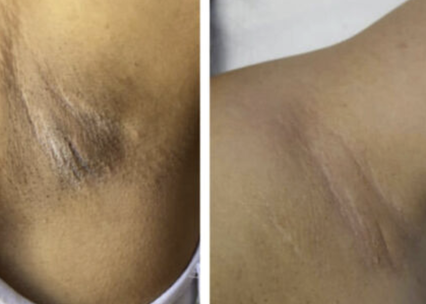 MD:Peel Intimate White <br> Világosító intim zóna peeling