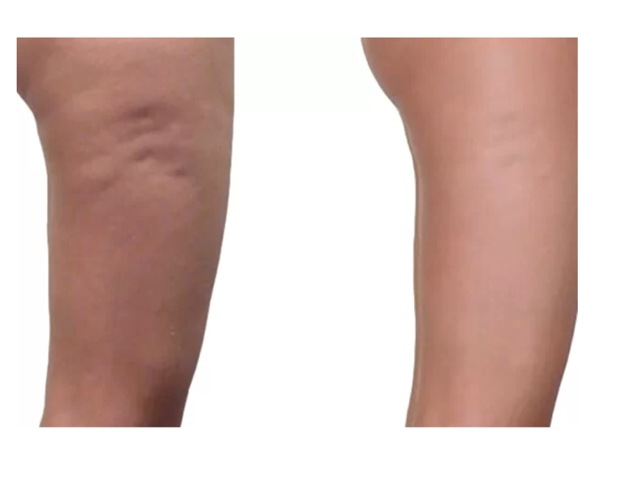 BEAUTYLIZER BODY Masážny prístroj pre redukciu celulitídy a tuku  Inteligentný body sculpting. Relaxácia a regenerácia.