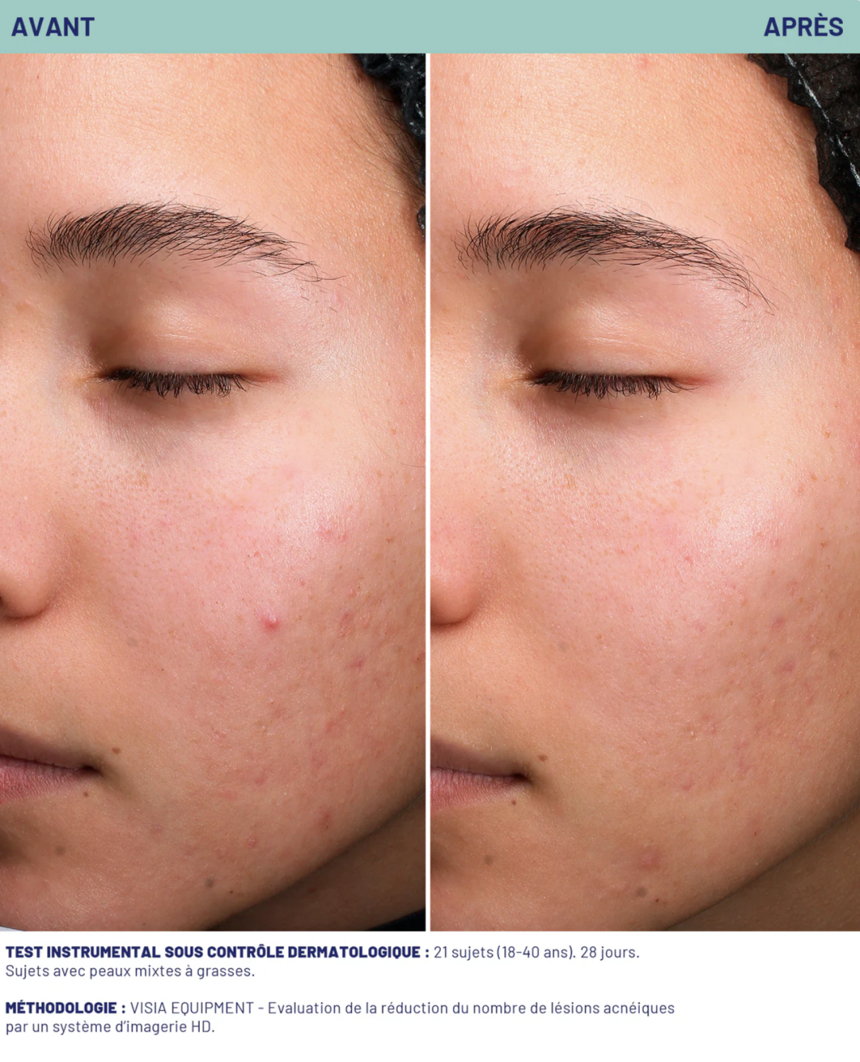 SOSKIN AKN STOP IMPERFECTION SERUM 
Gyulladt aknés területekre 15 ml.